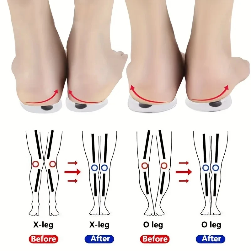 Women Shoes Types - 1 Paar Orthopedische Inlegzolen Voor Voeten